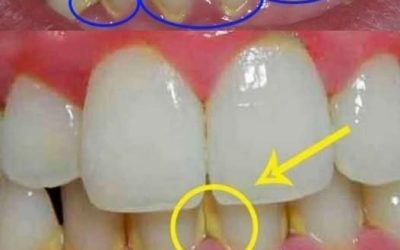 Usuń płytkę nazębną w 5 minut naturalnie, bez chodzenia do dentysty